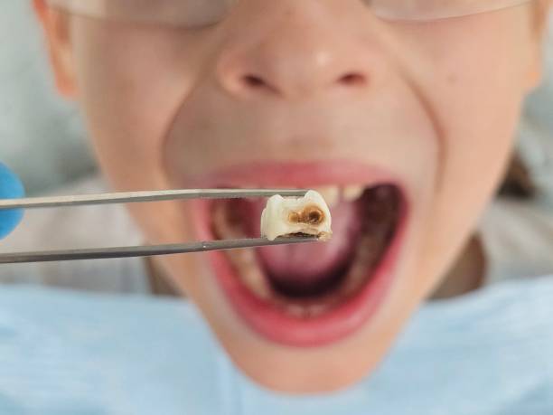 Best Emergency Treatment for Oral Infections in College Station, TX